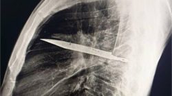 Pria Kritis di Sampit, Pisau Ditemukan