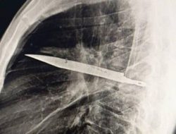 Pria Kritis di Sampit, Pisau Ditemukan